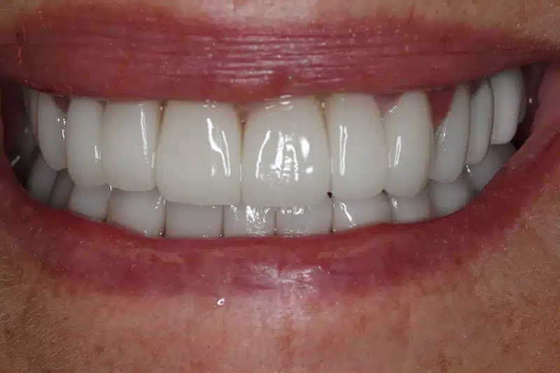 After Full Mouth Rehabilitation