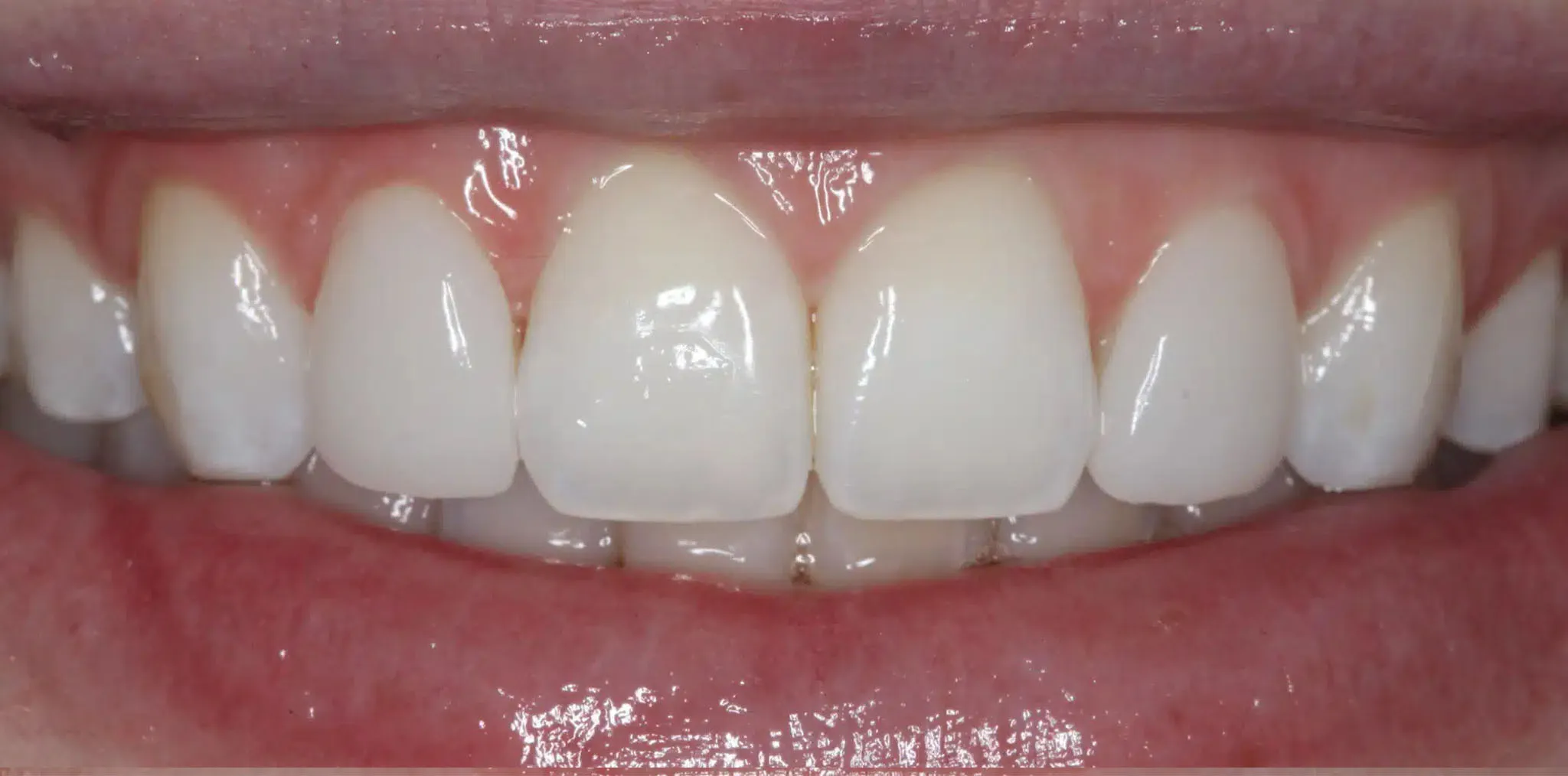 After Preepless Veneers