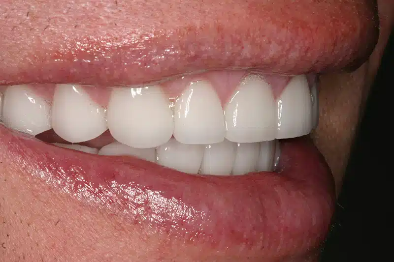 Bulimia Cosmetic Dentistry