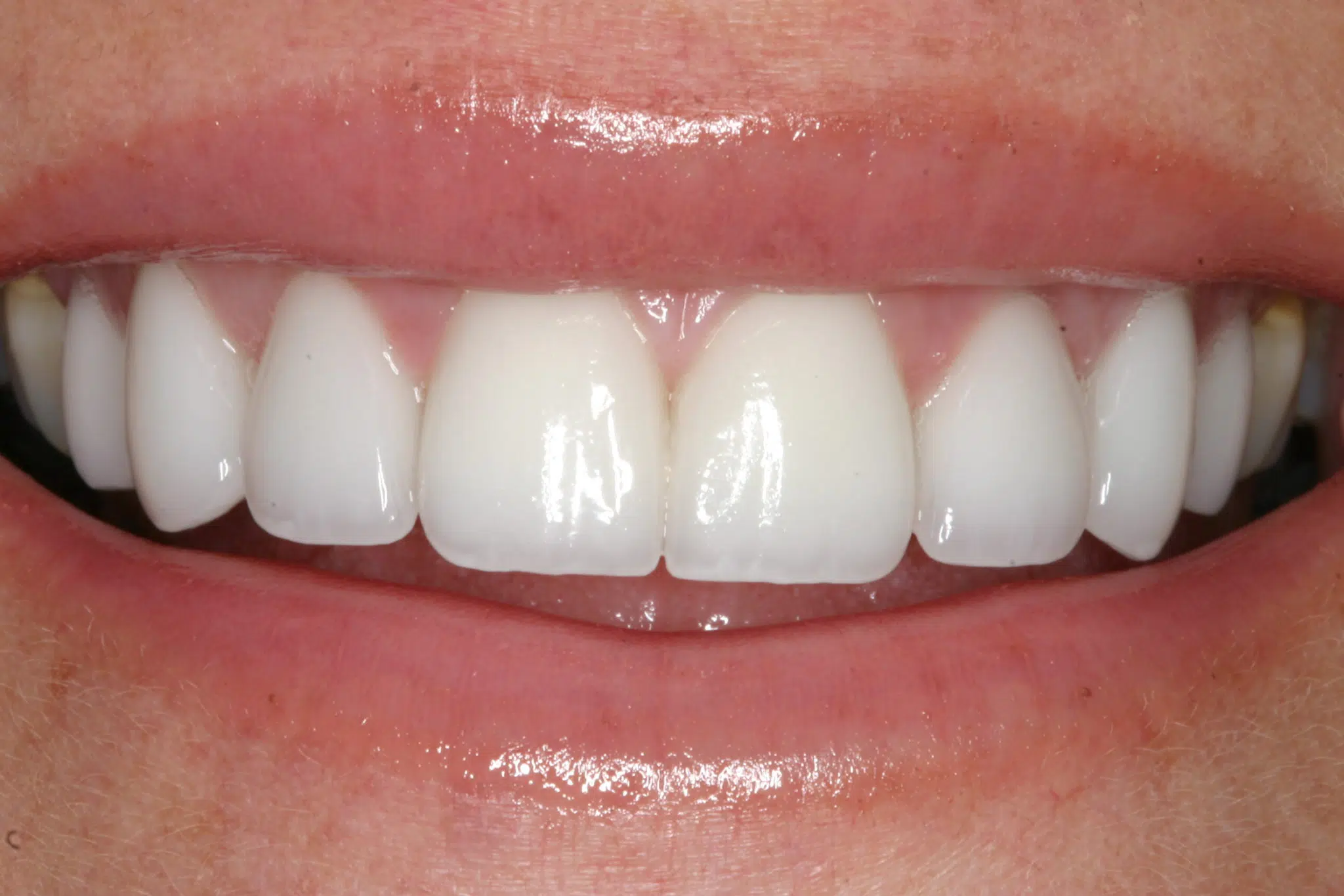 Porcelain Veneers in Allentown