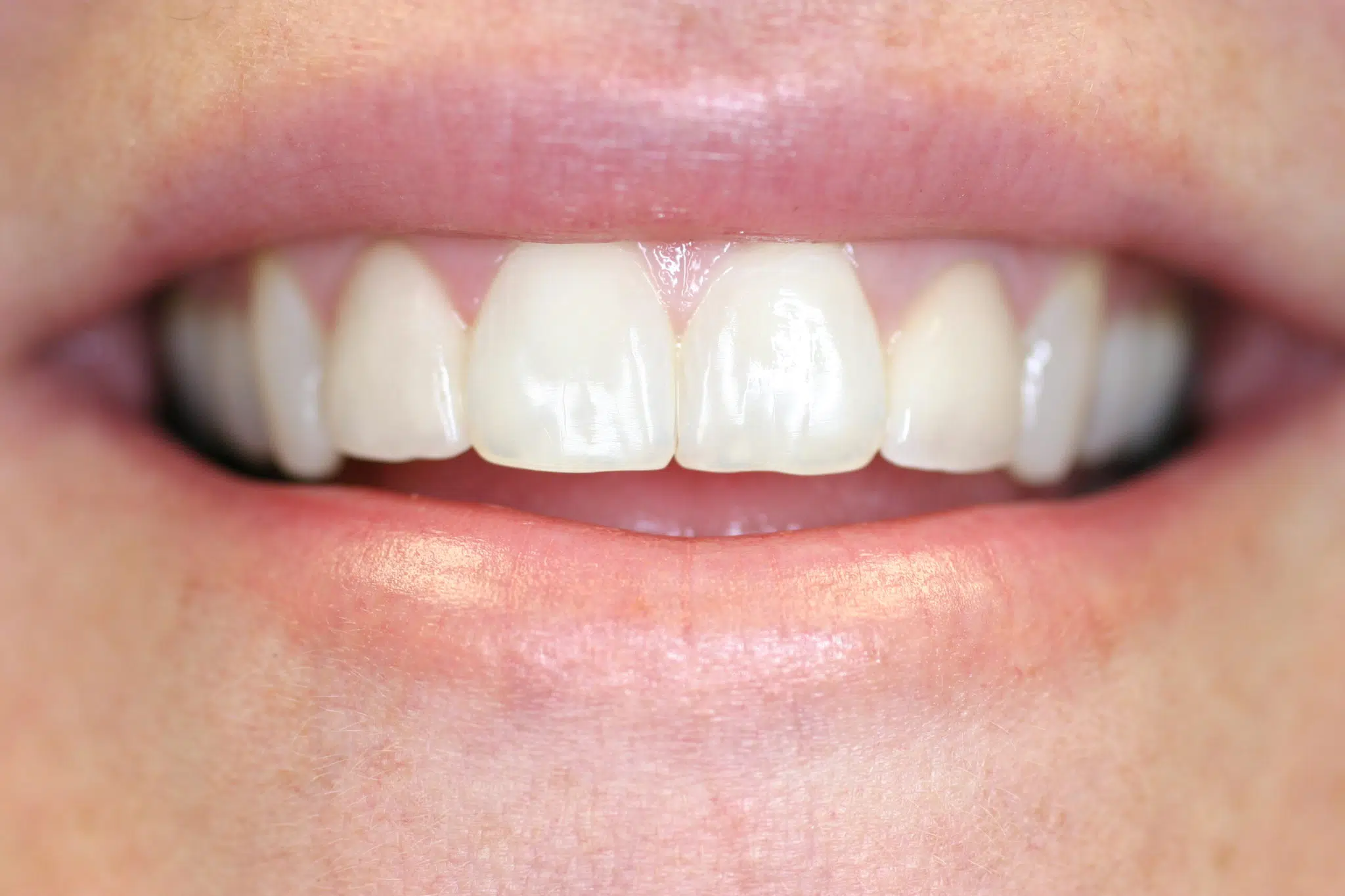 Porcelain Veneers