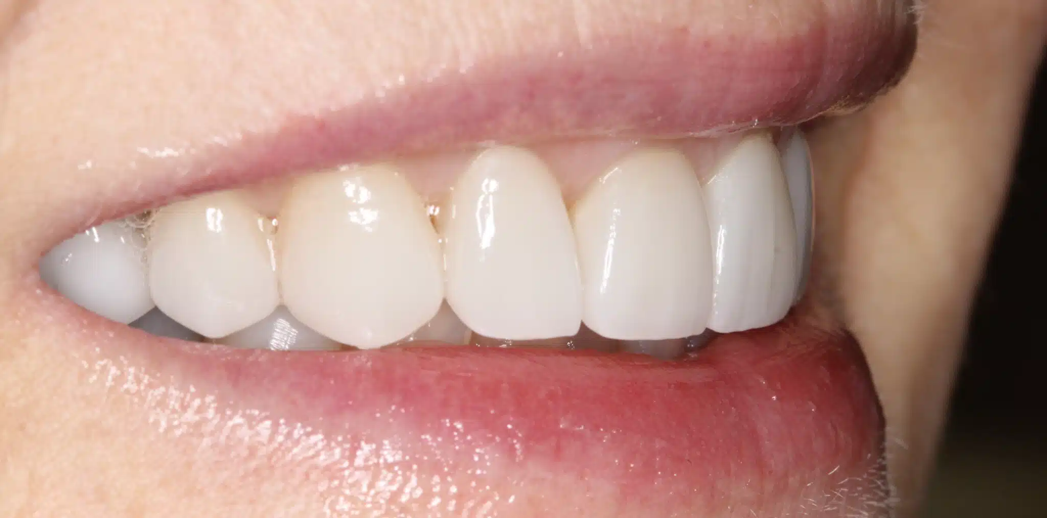 prepless veneers after