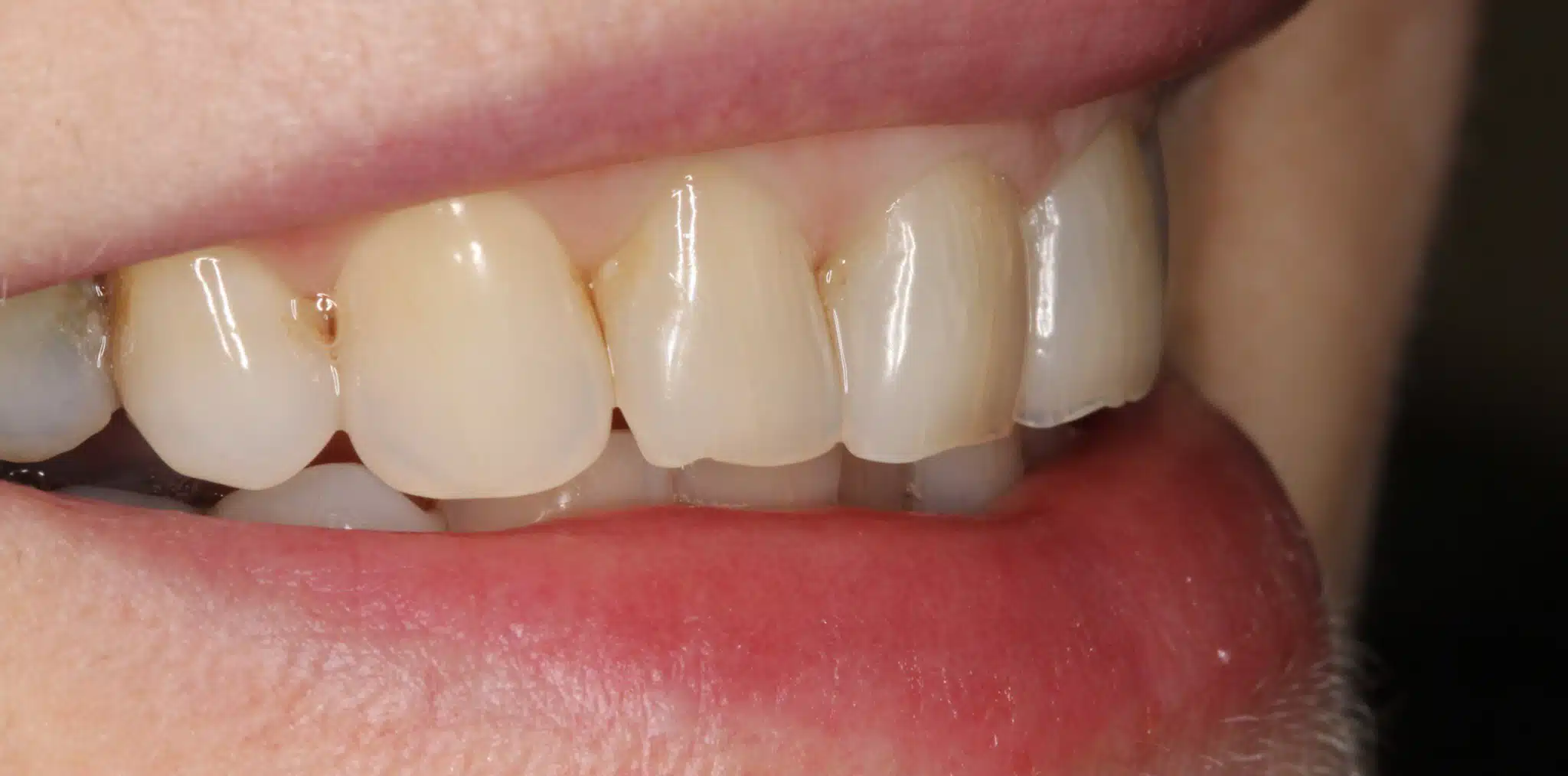 prepless veneers before