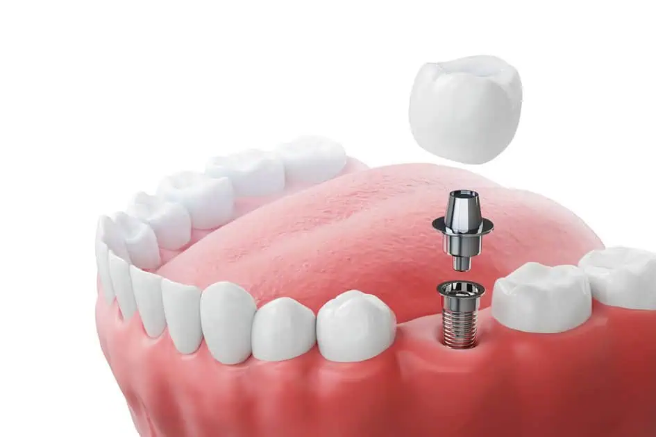 Dental Implants by Mary Elizabeth Viechnicki DMD in Allentown, PA