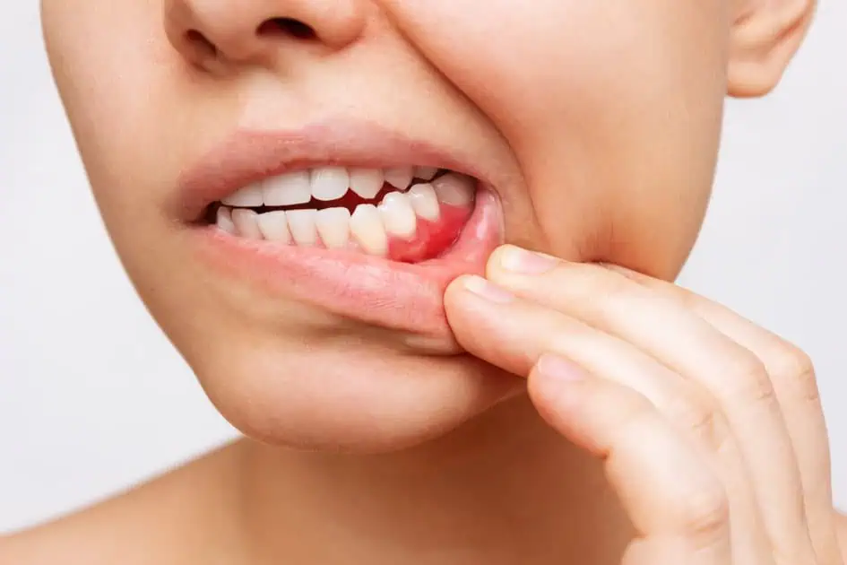 Gum Disease by Mary Elizabeth Viechnicki DMD in Allentown, PA