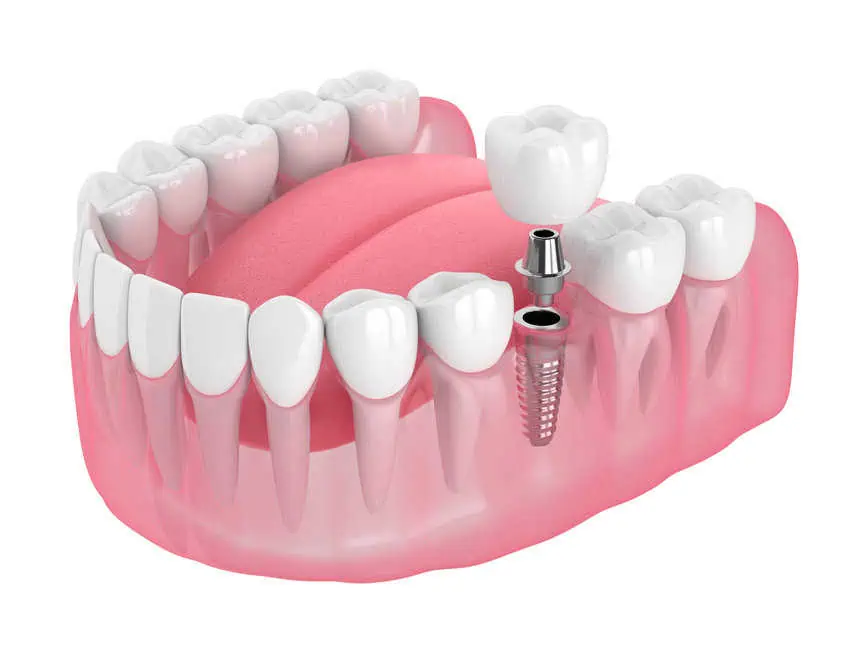 Dental Implants by Mary Elizabeth Viechnicki in Allentown, PA